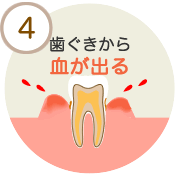 歯ぐきから血が出る